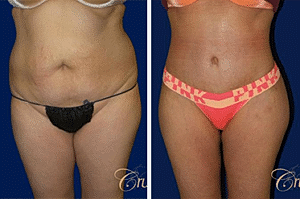 A Guide to Tummy Tuck: What You Should Know