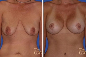 An Overview of Popular Breast Procedures: What Are Your Options?