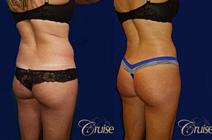 Answering Your Top Brazilian Butt Lift Questions