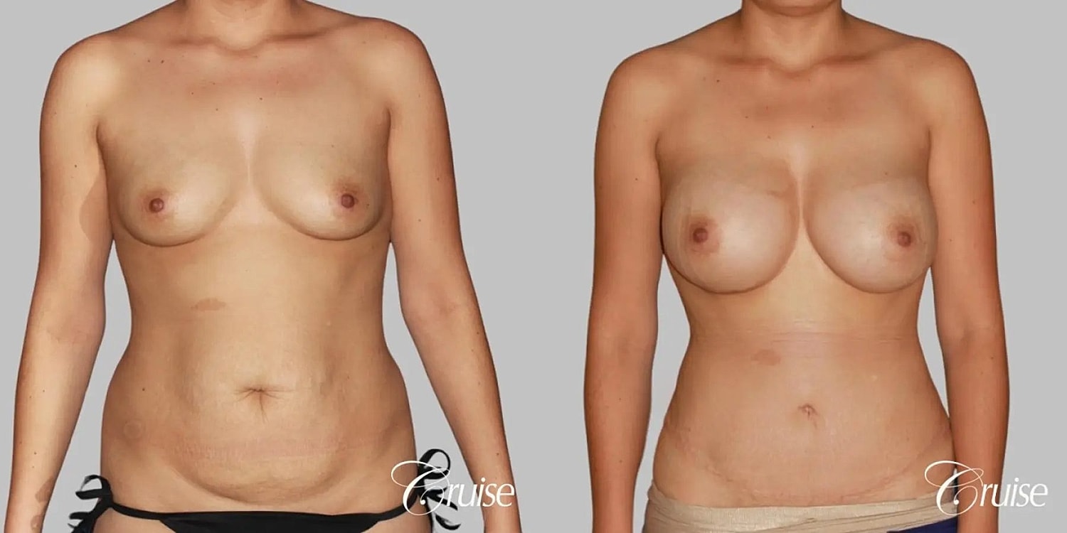Tummy Tuck Before & After