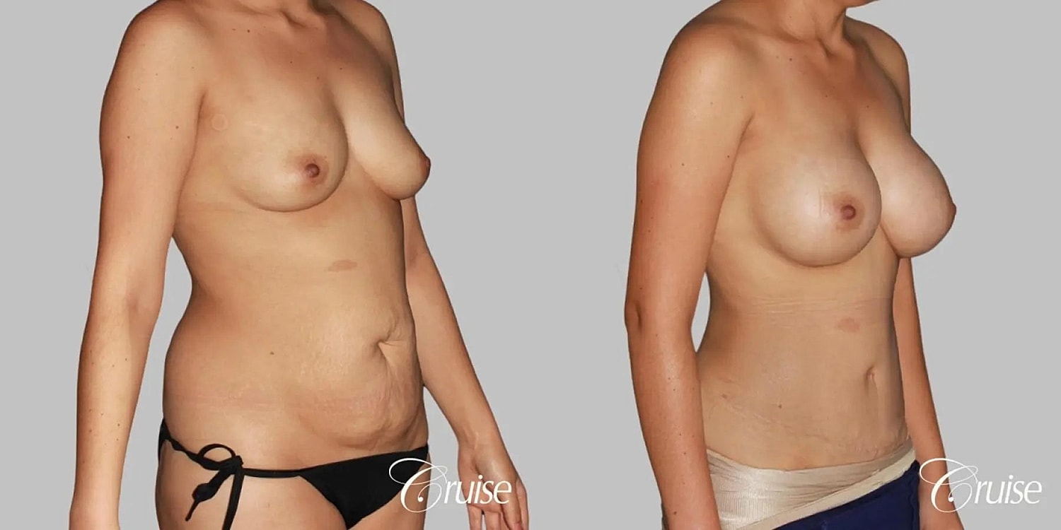 Tummy Tuck Before & After