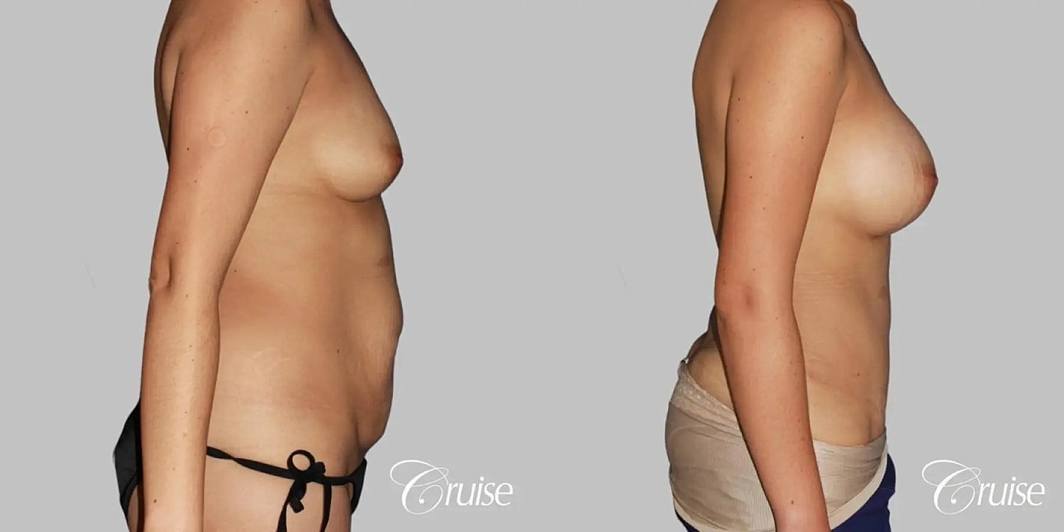Tummy Tuck Before & After