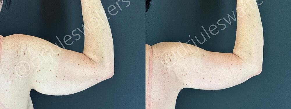 Arm Lift Brachioplasty Before & After