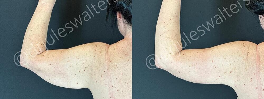 Arm Lift Brachioplasty Before & After
