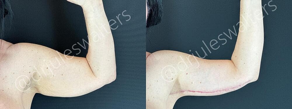 Arm Lift Brachioplasty Before & After