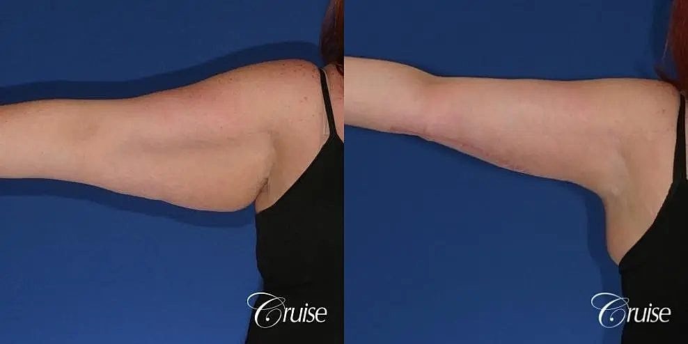 Arm Lift Before & After
