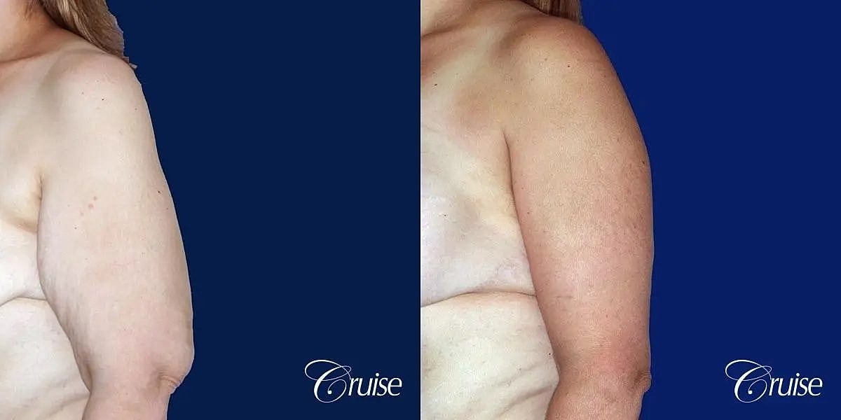 Arm Lift Before & After