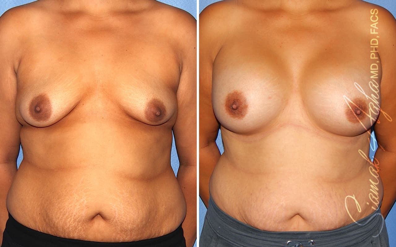 Tubular Breast Correction Before & After
