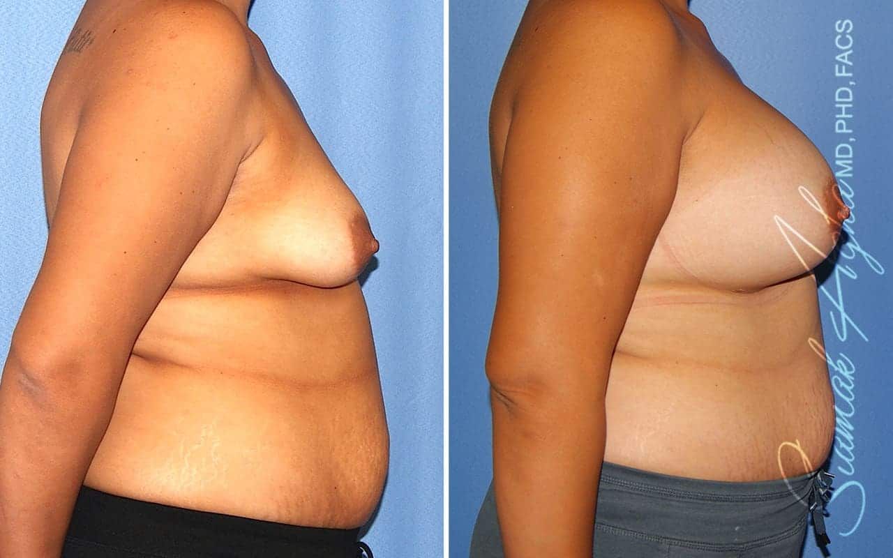 Tubular Breast Correction Before & After