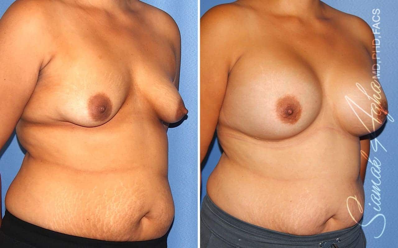 Tubular Breast Correction Before & After