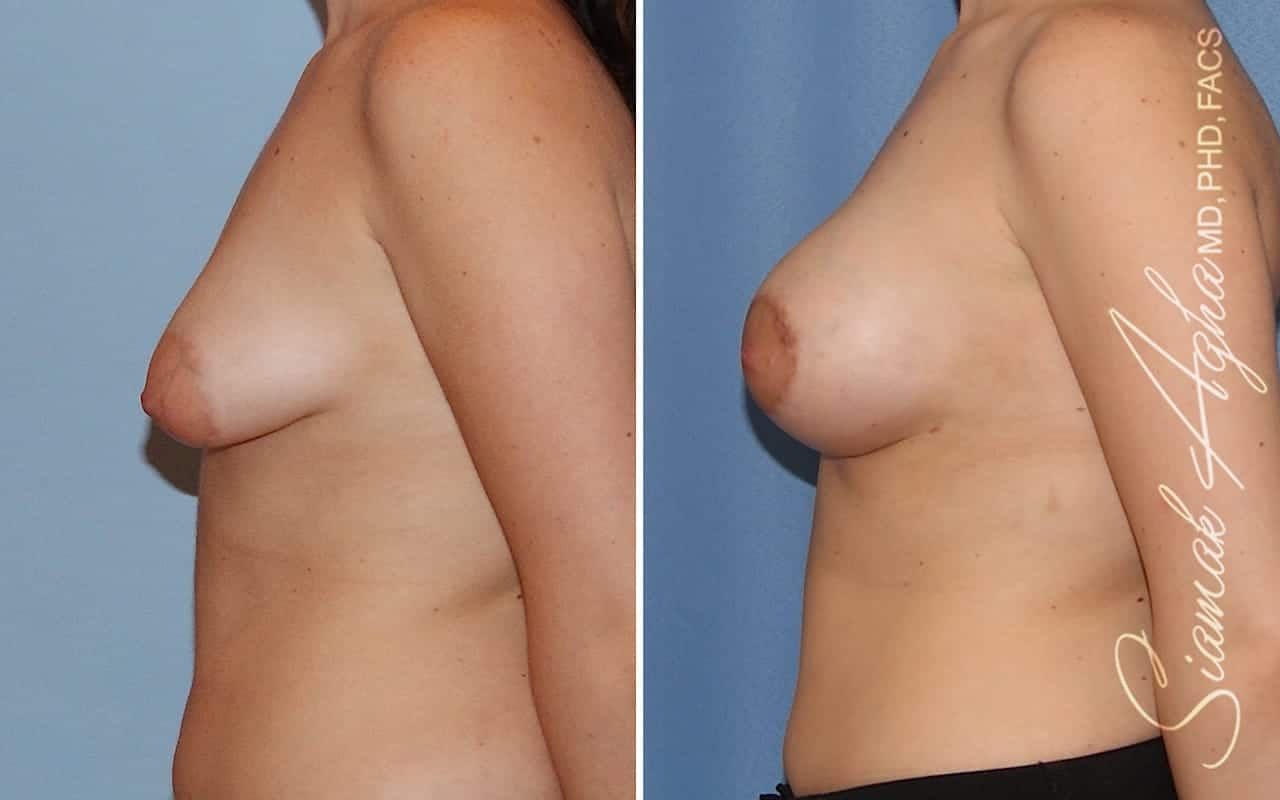 Tubular Breast Correction Before & After