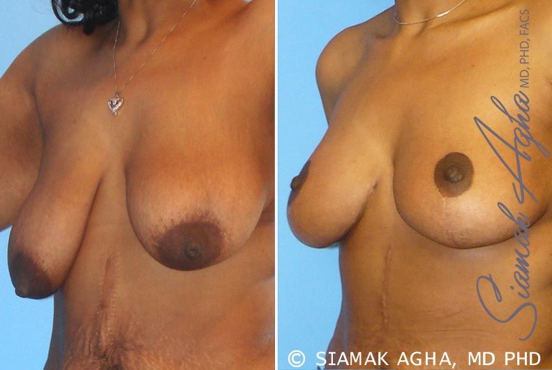 Breast Lift Before & After