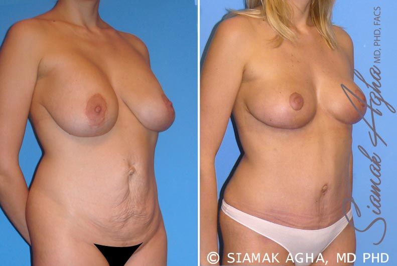 Breast Lift Before & After