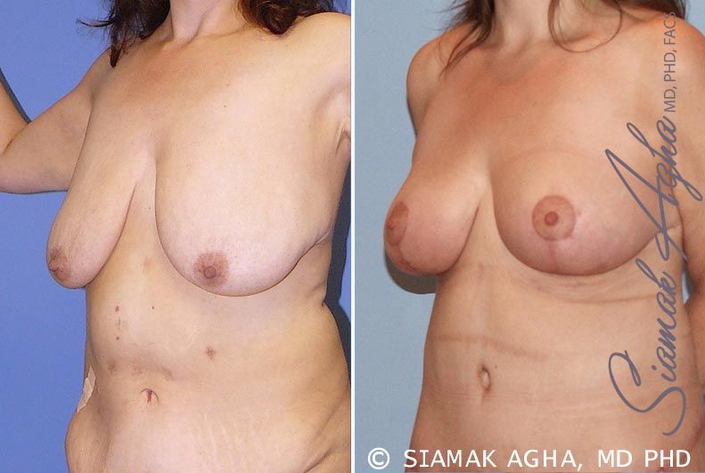 Breast Lift Before & After