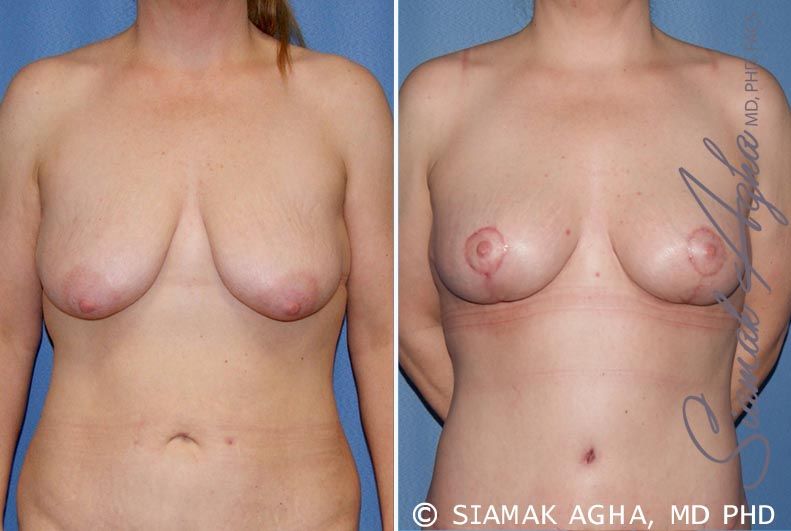 Breast Lift Before & After