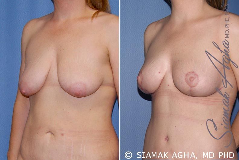 Breast Lift Before & After