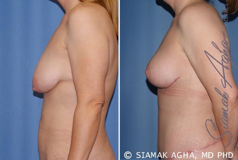 Breast Lift Before & After