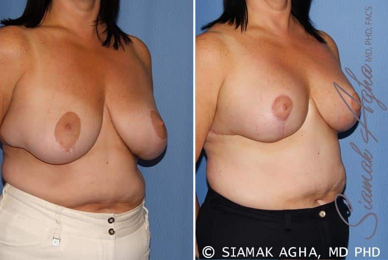 Breast Lift Before & After