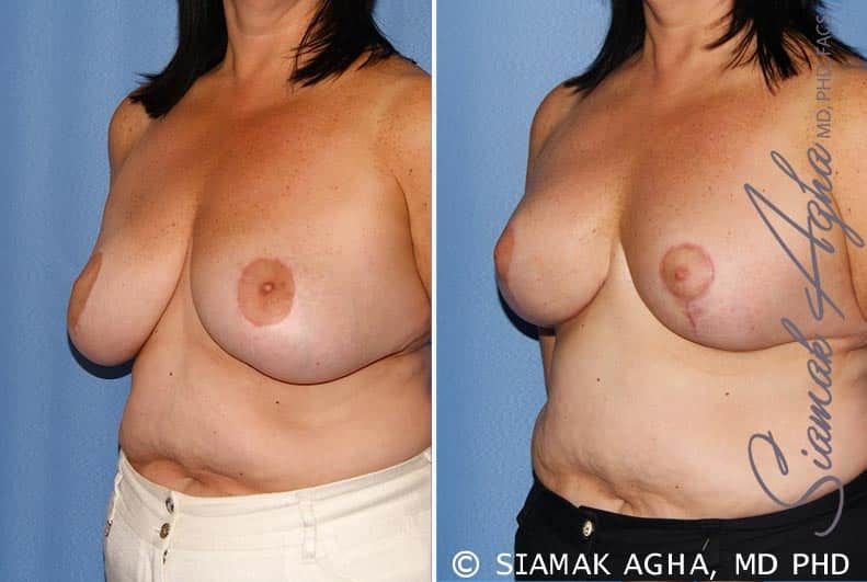 Breast Lift Before & After