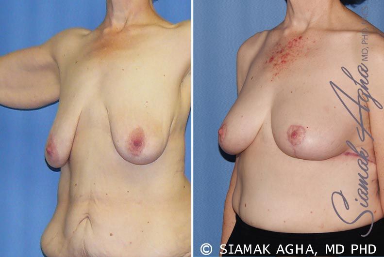 Breast Lift Before & After