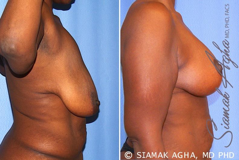 Breast Lift Before & After