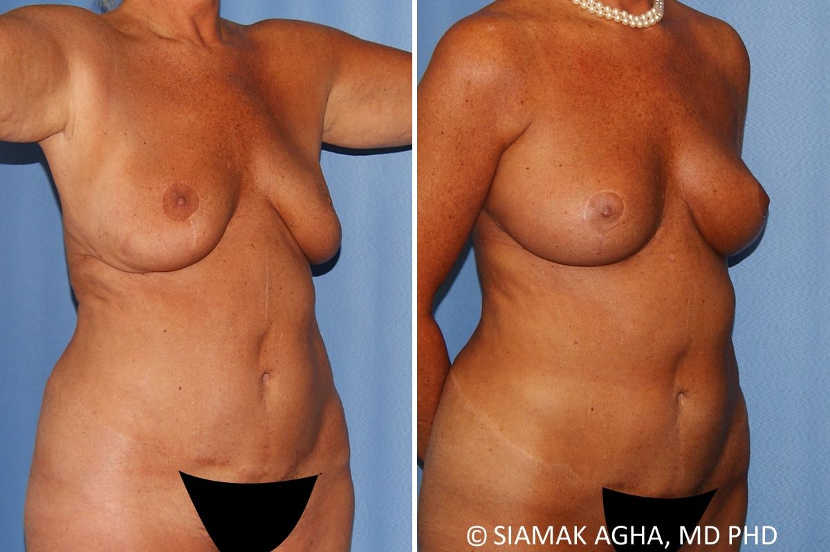 Breast Lift Before & After