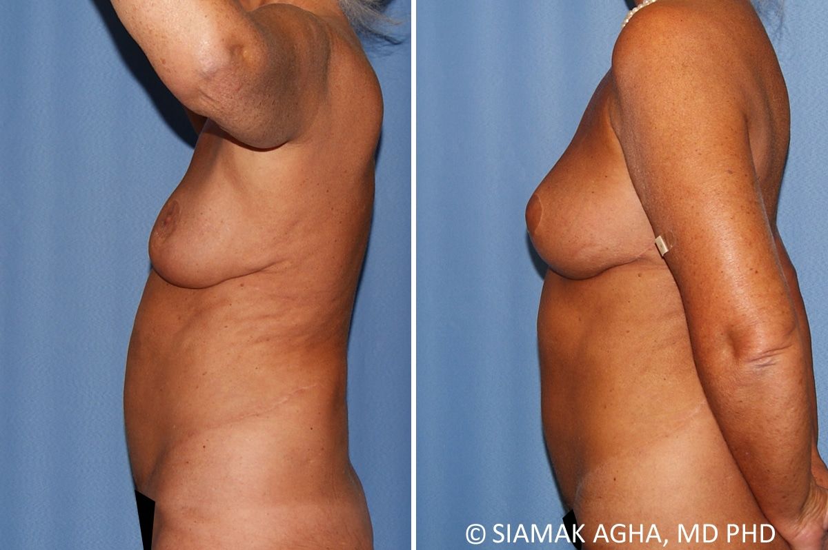 Breast Lift Before & After
