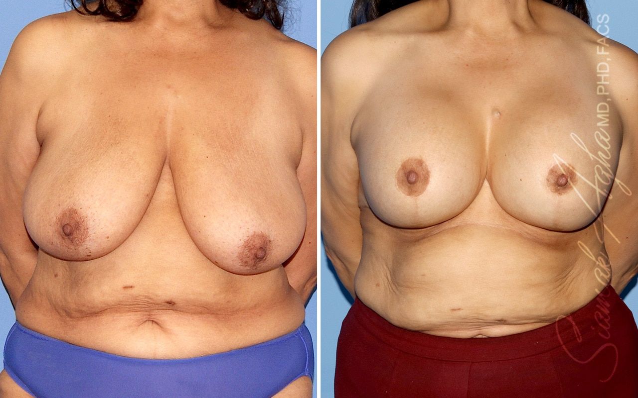 Breast Lift Before & After