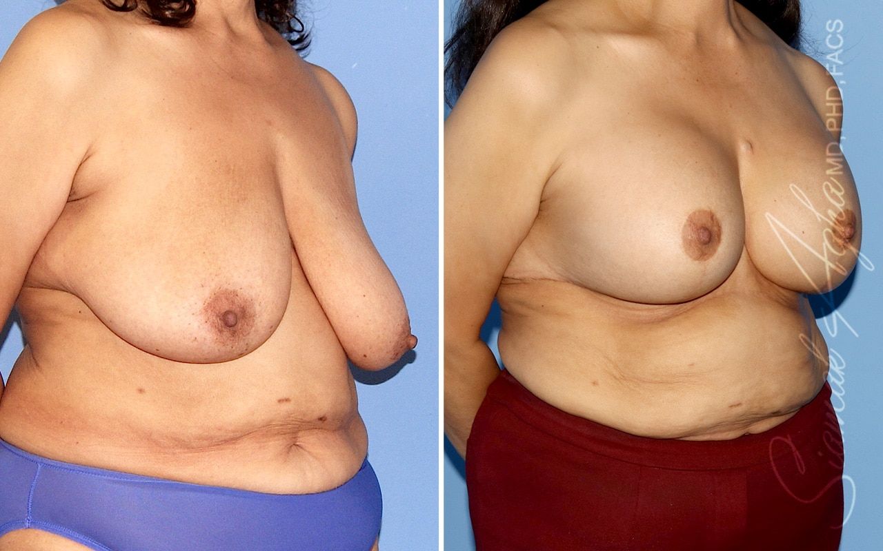 Breast Lift Before & After