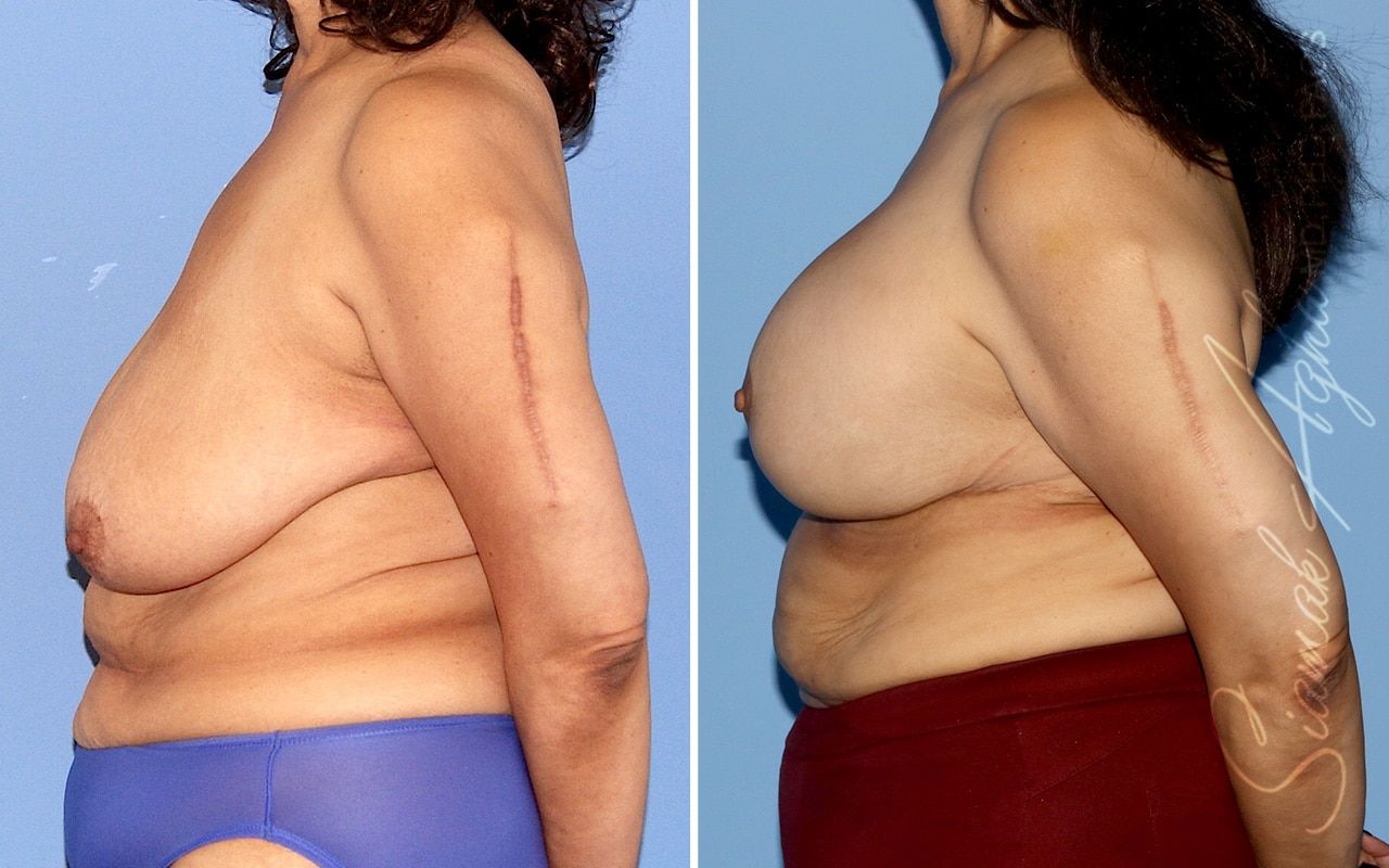 Breast Lift Before & After