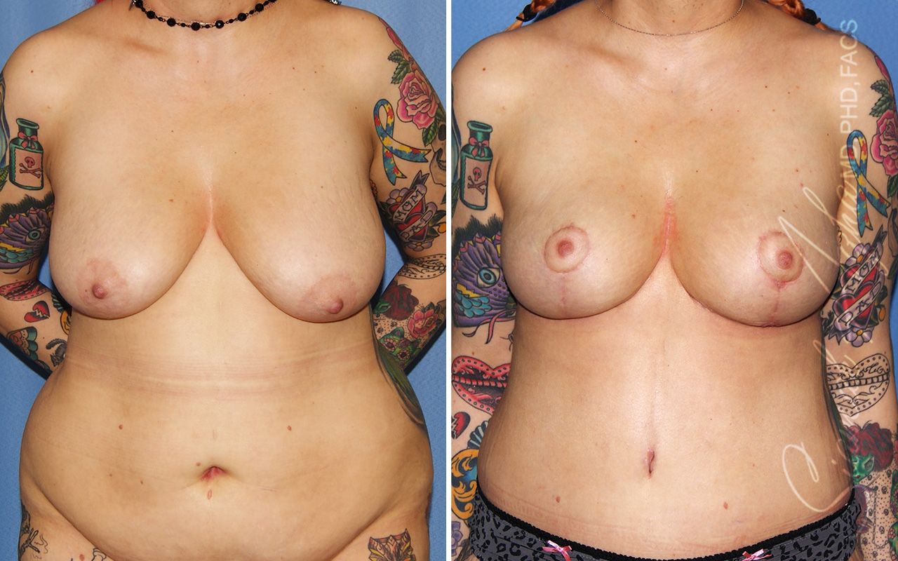 Breast Lift Before & After