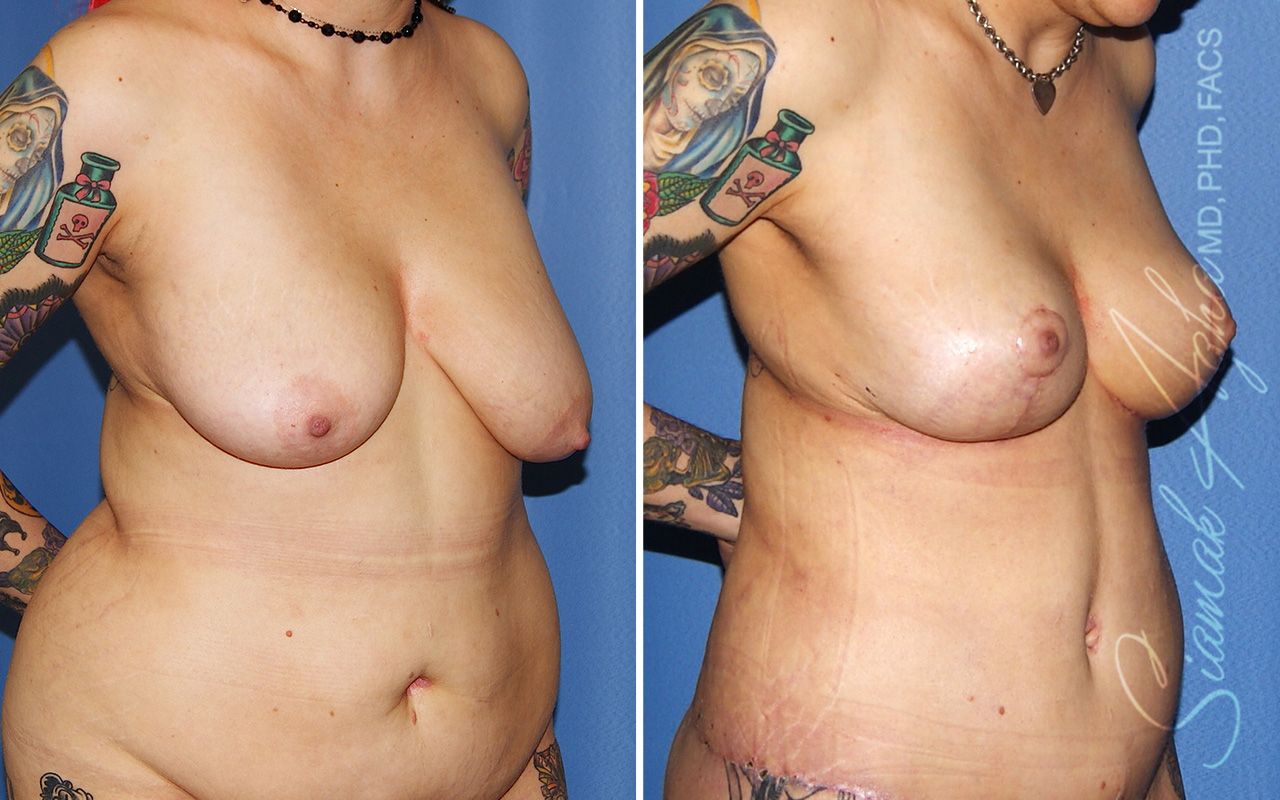 Breast Lift Before & After
