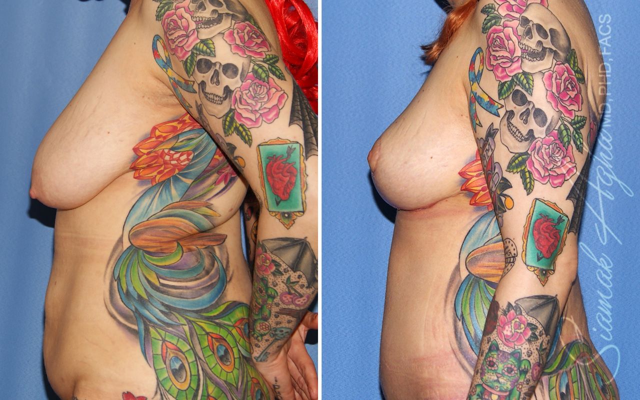 Breast Lift Before & After