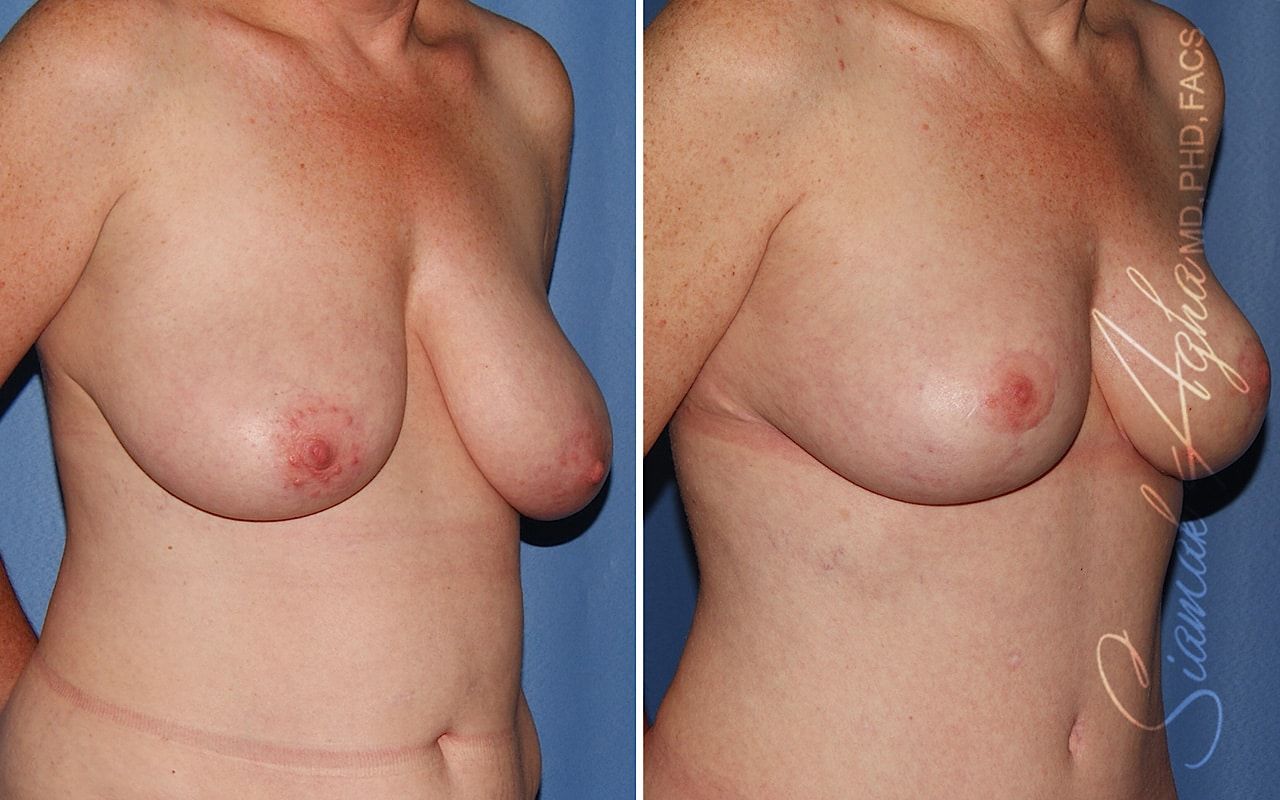 Breast Lift Before & After