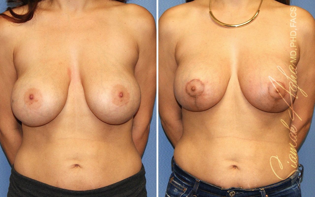 Breast Lift Before & After