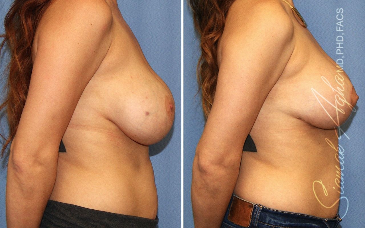 Breast Lift Before & After