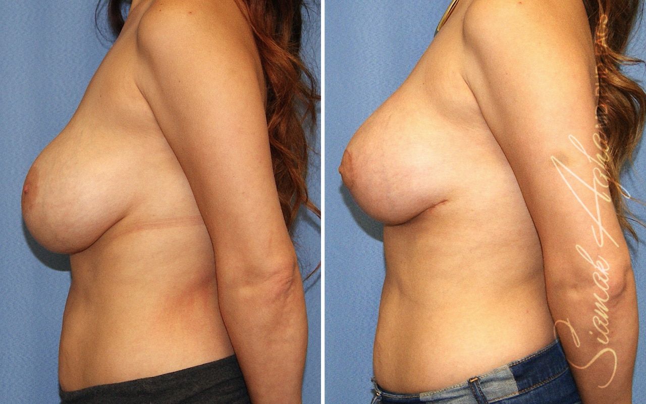 Breast Lift Before & After