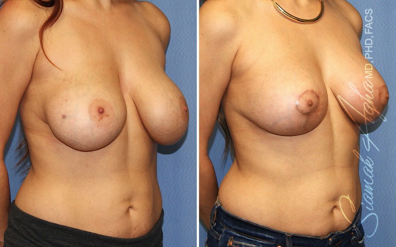 Breast Lift Before & After