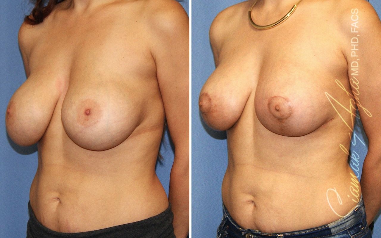 Breast Lift Before & After
