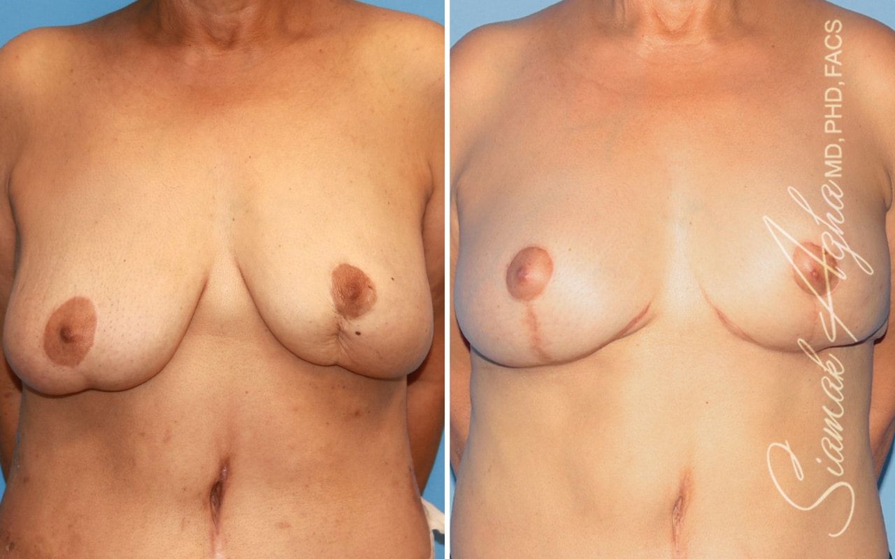 Breast Lift Before & After