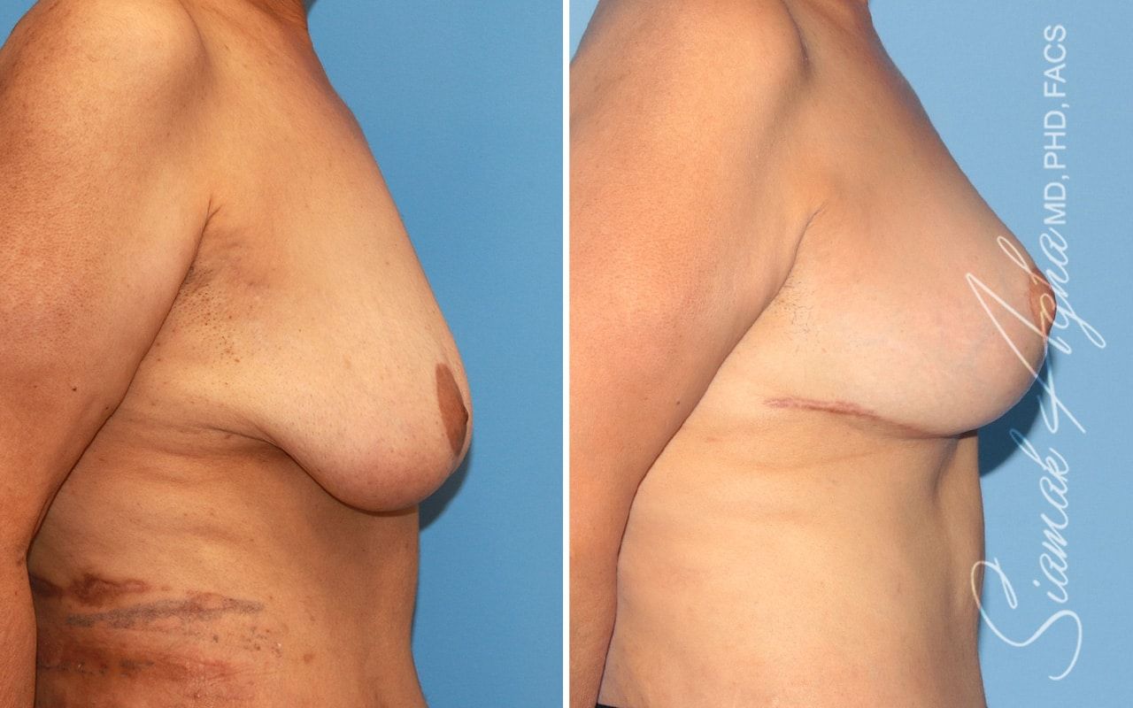 Breast Lift Before & After