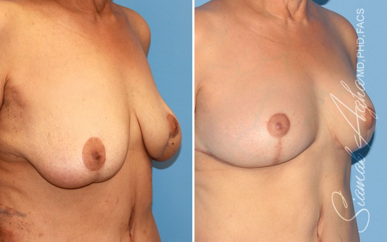 Breast Lift Before & After
