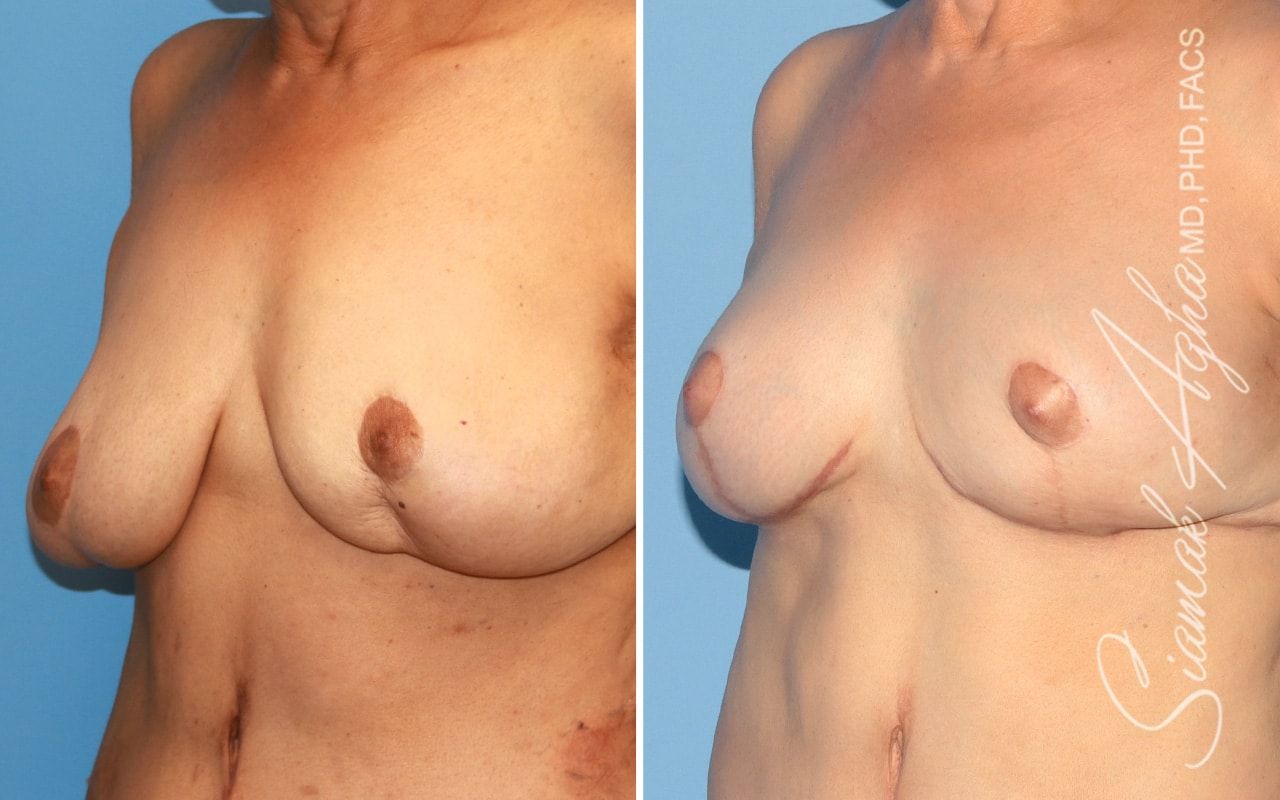 Breast Lift Before & After