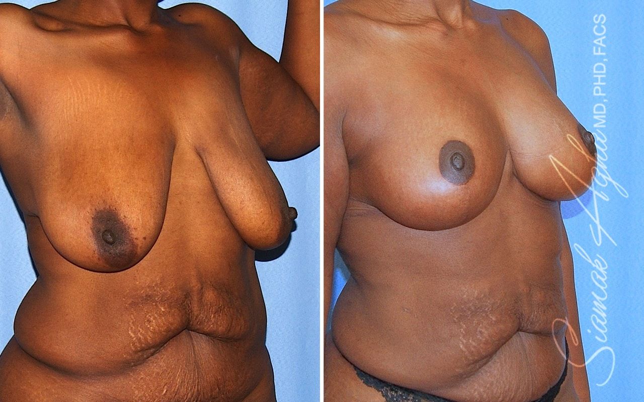 Breast Lift Before & After
