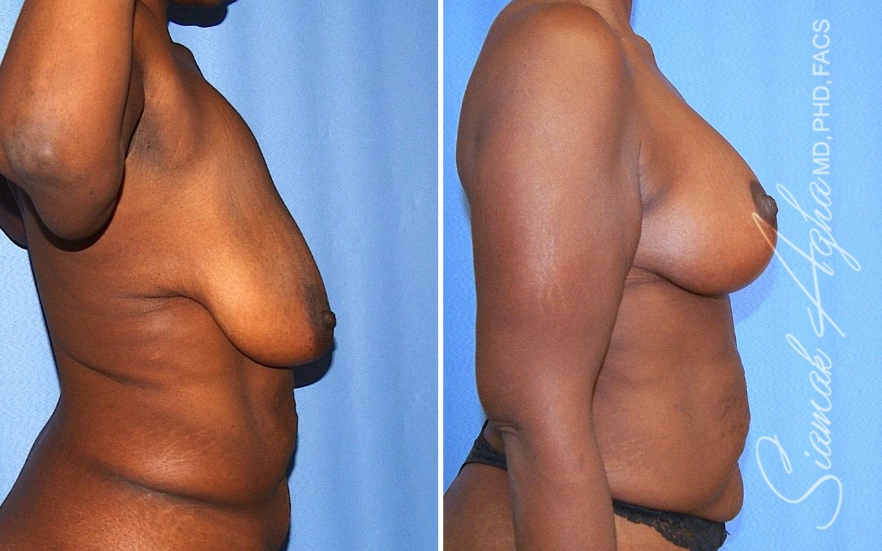 Breast Lift Before & After