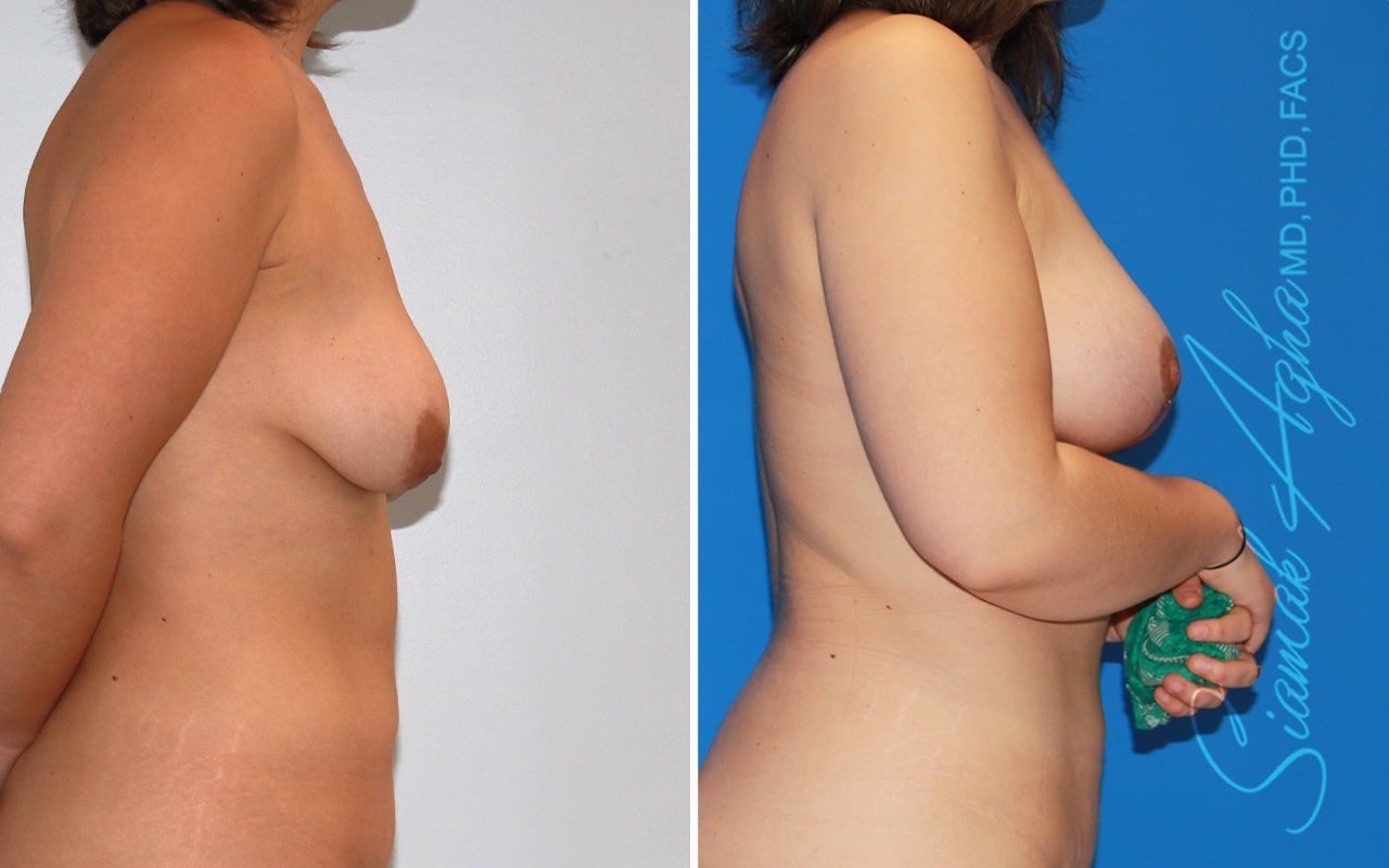 Breast Lift Before & After