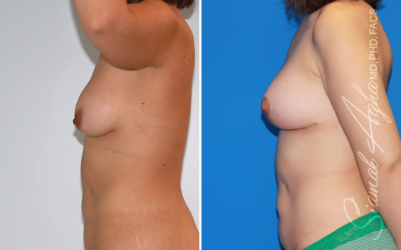Breast Lift Before & After