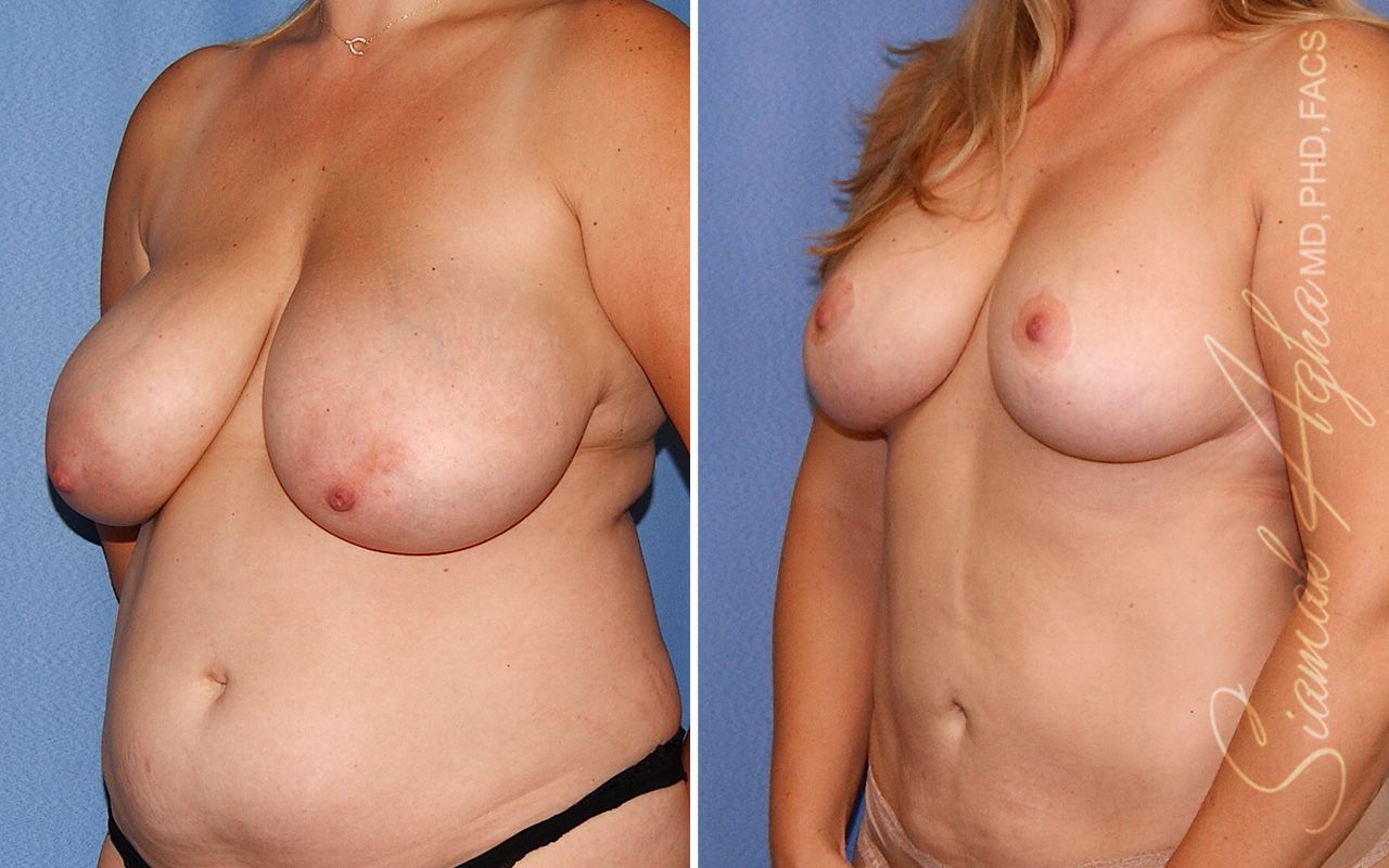Breast Lift Before & After