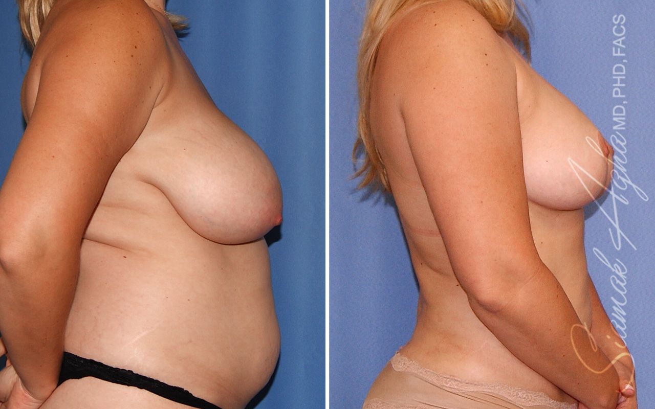 Breast Lift Before & After