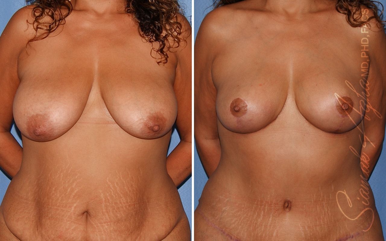Breast Lift Before & After